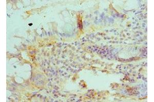 Immunohistochemistry of paraffin-embedded human colon cancer using ABIN7145627 at dilution of 1:100 (BLMH 抗体  (AA 1-300))