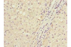 Immunohistochemistry of paraffin-embedded human liver cancer using ABIN7165661 at dilution of 1:100 (IWS1 抗体  (AA 570-819))