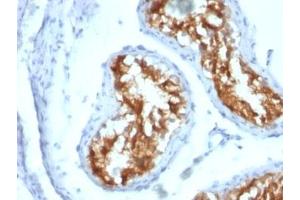 Formalin-fixed, paraffin-embedded human testicular carcinoma stained with Fascin antibody (FSCN1/417) (Fascin 抗体)