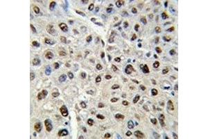 IHC analysis of FFPE human hepatocarcinoma stained with SS-B antibody (SSB 抗体  (AA 366-397))