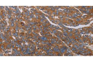 Immunohistochemistry of paraffin-embedded Human ovarian cancer tissue using PARP10 Polyclonal Antibody at dilution 1:30 (PARP10 抗体)