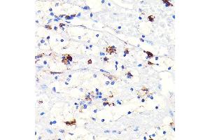 Immunohistochemistry of paraffin-embedded human kidney cancer using Heme Oxygenase 1 (HO-1/HMOX1) (HO-1/HMOX1) Rabbit mAb  at dilution of 1:100 (40x lens).