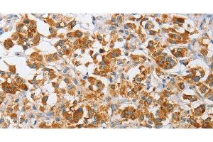 Immunohistochemistry of paraffin-embedded Human thyroid cancer using ARHGEF9 Polyclonal Antibody at dilution of 1:50 (Arhgef9 抗体)