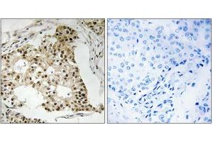Immunohistochemical staining of paraffin-embedded human breast carcinoma tissue reacted with RARA (phospho S77) polyclonal antibody  at 1:50-1:100 dilution. (Retinoic Acid Receptor alpha 抗体  (pSer77))