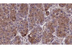 ABIN6273978 at 1/100 staining Human liver cancer tissue by IHC-P. (OR2L3/2L8 抗体)