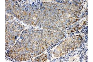 IHC testing of FFPE human lung cancer tissue with TECTA antibody at 1ug/ml. (TECTA 抗体  (AA 93-134))