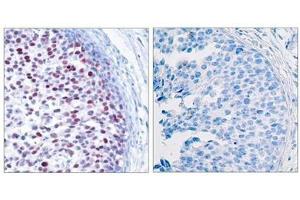Immunohistochemical analysis of paraffin-embedded human breast carcinoma tissue using c-Jun(Phospho-Thr239) Antibody(left) or the same antibody preincubated with blocking peptide(right). (C-JUN 抗体  (pThr239))