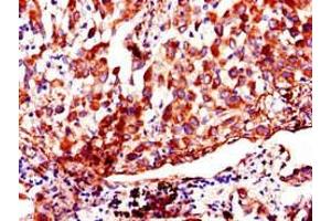 Immunohistochemistry of paraffin-embedded human lung cancer using ABIN7142915 at dilution of 1:100 (AKAP9 抗体  (AA 71-191))