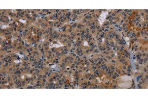 Immunohistochemistry of paraffin-embedded Human thyroid cancer tissue using NPRL2 Polyclonal Antibody at dilution 1:50 (NPRL2 抗体)