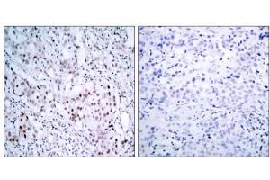 Immunohistochemical analysis of paraffin-embedded human breast carcinoma tissue using c-Jun (phospho- ser63) antibody (E011001). (C-JUN 抗体  (pSer63))