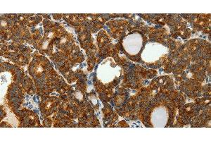 Immunohistochemistry of paraffin-embedded Human thyroid cancer tissue using SELENOM Polyclonal Antibody at dilution 1:50 (SELM 抗体)