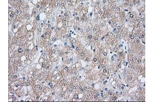 Immunohistochemical staining of paraffin-embedded Human liver tissue using anti-HSPA1A mouse monoclonal antibody. (HSP70 1A 抗体)