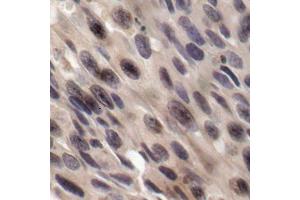 Immunohistochemistry of paraffin-embedded human breast carcinoma, using Phospho-EIF4EBP1-T36 antibody (ABIN2987995). (eIF4EBP1 抗体  (pThr36))