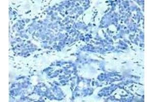 Immunohistochemistry of paraffin-embedded human thyroid cancer (treated with synthetic peptide) using ABIN7190935 at dilution of 1:20 (HES1 抗体)