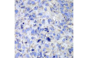 Immunohistochemistry of paraffin-embedded human lung cancer using Casp7 antibody at dilution of 1:100 (400x lens). (Caspase 7 抗体)