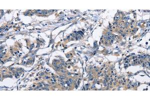 Immunohistochemistry of paraffin-embedded Human gastric cancer using CAPZA2 Polyclonal Antibody at dilution of 1:30 (CAPZA2 抗体)