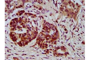 IHC image of ABIN7169579 diluted at 1:400 and staining in paraffin-embedded human pancreatic cancer performed on a Leica BondTM system. (Sialidase 4 抗体  (AA 225-377))