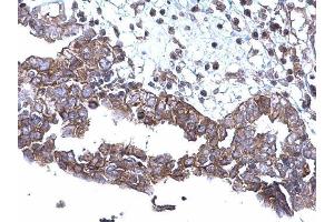 IHC-P Image SQSTM1 antibody [N3C1], Internal detects SQSTM1 protein at cytoplasm on human ovarian carcinoma by immunohistochemical analysis. (SQSTM1 抗体)