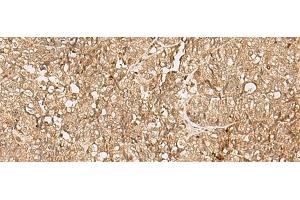 Immunohistochemistry of paraffin-embedded Human ovarian cancer tissue using SNAPC5 Polyclonal Antibody at dilution of 1:25(x200) (SNAPC5 抗体)