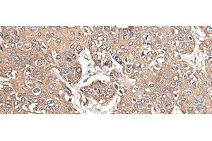Immunohistochemistry of paraffin-embedded Human prost at e cancer tissue using KRT73 Polyclonal Antibody at dilution of 1:55(x200) (KRT73 抗体)