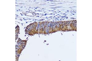 Immunohistochemistry of paraffin-embedded human colon carcinoma using [KO Validated] RhoA Rabbit pAb (ABIN7269865) at dilution of 1:350 (40x lens). (RHOA 抗体  (AA 1-193))