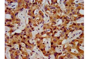 IHC image of ABIN7155063 diluted at 1:200 and staining in paraffin-embedded human liver cancer performed on a Leica BondTM system. (ONECUT1 抗体  (AA 192-292))