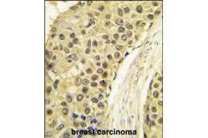 Formalin-fixed and paraffin-embedded human breast carcinoma tissue reacted with CCNA2 antibody , which was peroxidase-conjugated to the secondary antibody, followed by DAB staining. (Cyclin A 抗体  (C-Term))