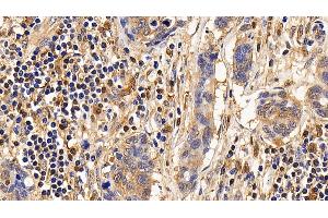 Immunohistochemistry (IHC) image for anti-Interleukin 13 Receptor, alpha 2 (IL13RA2) (AA 238-334) antibody (ABIN7437515)
