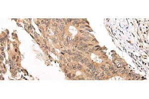 Immunohistochemistry of paraffin-embedded Human colorectal cancer tissue using CHAMP1 Polyclonal Antibody at dilution of 1:40(x200) (ZNF828 抗体)