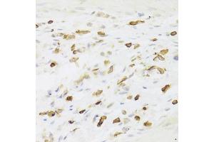 Immunohistochemistry of paraffin-embedded human gastric cancer using LSP1 Antibody (ABIN6130532, ABIN6143368, ABIN6143370 and ABIN6221252) at dilution of 1:100 (40x lens). (LSP1 抗体  (AA 1-339))