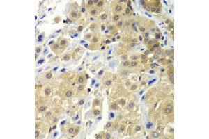 Immunohistochemistry of paraffin-embedded human liver cancer using SGTA antibody at dilution of 1:100 (x40 lens). (SGTA 抗体)