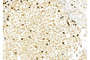 ABIN6262151 and ABIN6277238 at 1/100 staining Human lung cancer and adjacent normal tissues by IHC-P. (TIM3 抗体  (C-Term))