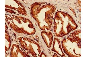 Immunohistochemistry of paraffin-embedded human prostate cancer using ABIN7158066 at dilution of 1:100 (LRRFIP1 抗体  (AA 1-315))
