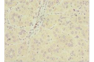 Immunohistochemistry of paraffin-embedded human liver cancer using ABIN7163200 at dilution of 1:100 (INPP5J 抗体  (AA 60-360))