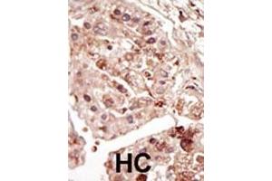 Formalin-fixed and paraffin-embedded human cancer tissue reacted with the primary antibody, which was peroxidase-conjugated to the secondary antibody, followed by DAB staining. (STK31 抗体  (C-Term))