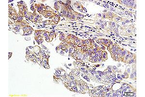 Formalin-fixed and paraffin embedded human ovarian cancer labeled with Anti-HER2 receptor(NT) Polyclonal Antibody, unconjugated (ABIN678068)  at 1: 200 followed by incubation with conjugated secondary antibody and DAB staining (ErbB2/Her2 抗体  (AA 151-250))