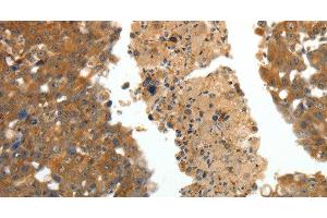 Immunohistochemistry of paraffin-embedded Human breast cancer using CRP Polyclonal Antibody at dilution of 1:80 (CRP 抗体)