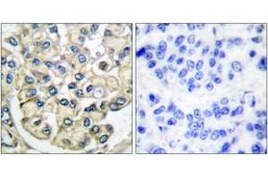 Immunohistochemistry analysis of paraffin-embedded human breast carcinoma tissue, using FGFR2 Antibody. (FGFR2 抗体  (AA 471-520))