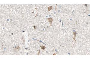 ABIN6274450 at 1/100 staining Human brain cancer tissue by IHC-P. (MADD 抗体  (Internal Region))