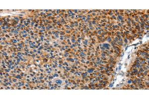 Immunohistochemistry of paraffin-embedded Human liver cancer using AMDHD2 Polyclonal Antibody at dilution of 1:40 (AMDHD2 抗体)