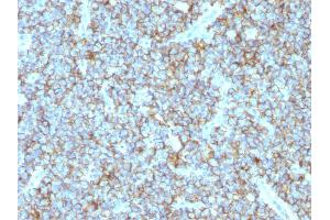 Formalin-fixed, paraffin-embedded human Ewing's sarcoma stained with CD99 Monoclonal Antibody (MIC2/877).