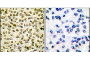 Immunohistochemistry analysis of paraffin-embedded human breast carcinoma, using Myc (Phospho-Ser62) Antibody. (c-MYC 抗体  (pSer62))