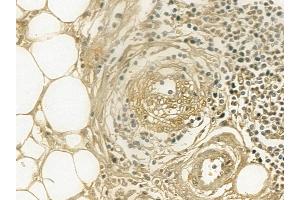 Cytokeratin 2e Mouse Monoclonal Antibody at 1/100 staining human pancreatic cancer and adjacent non-tumor tissue by IHC-P. (Keratin 2 抗体  (N-Term))
