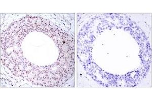 Immunohistochemistry analysis of paraffin-embedded human breast carcinoma, using NF-kappaB p65 (Phospho-Thr254) Antibody. (NF-kB p65 抗体  (pThr254))