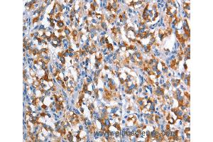 Immunohistochemistry of Human gastric cancer using CD226 Polyclonal Antibody at dilution of 1:60 (CD226 抗体)