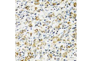 Immunohistochemistry of paraffin-embedded human uterine cancer using HSPA9 antibody (ABIN5970207) at dilution of 1/100 (40x lens). (HSPA9 抗体)