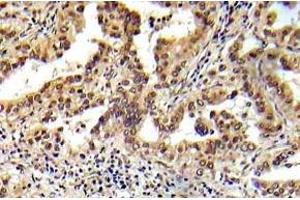 Immunohistochemistry (IHC) analyzes of Tsc2 antibody in paraffin-embedded human prostate carcinoma tissue. (Tuberin 抗体)