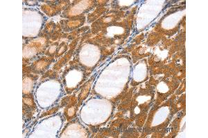 Immunohistochemistry of Human thyroid cancer using SRGAP3 Polyclonal Antibody at dilution of 1:40 (SRGAP3 抗体)