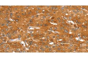 Immunohistochemistry of paraffin-embedded Human liver cancer tissue using ABCC9 Polyclonal Antibody at dilution 1:50 (ABCC9 抗体)