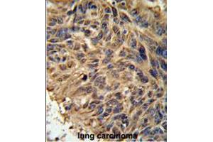 FBXL2 Antibody IHC analysis in formalin fixed and paraffin embedded human lung carcinoma followed by peroxidase conjugation of the secondary antibody and DAB staining. (FBXL2 抗体  (C-Term))